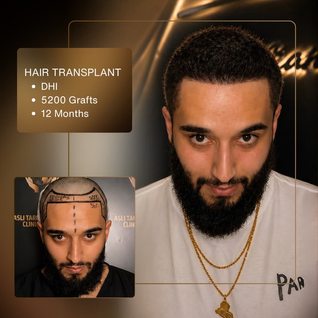 Before & After - DHI 5,200 Grafts