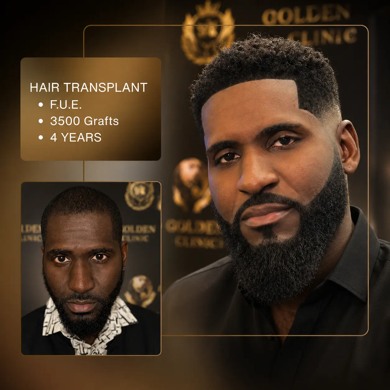 Before & After - D.H.I. 4,800 Grafts